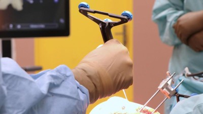 Inovace v kloubní endoprotetice: ústecká Masarykova nemocnice nasadila dalšího robota, tentokrát systém CORI s AI pro kloubní náhrady
