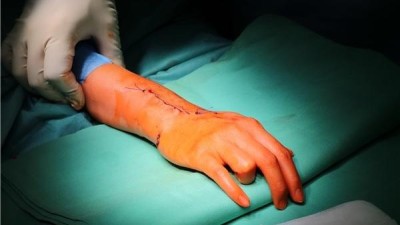 Chomutovští lékaři nahradili pacientce zápěstní kůstku implantátem z 3D tiskárny